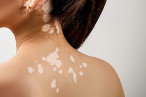 Foods that you should eat if you have vitiligo