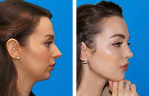 Mentoplasty Or Chin Surgery