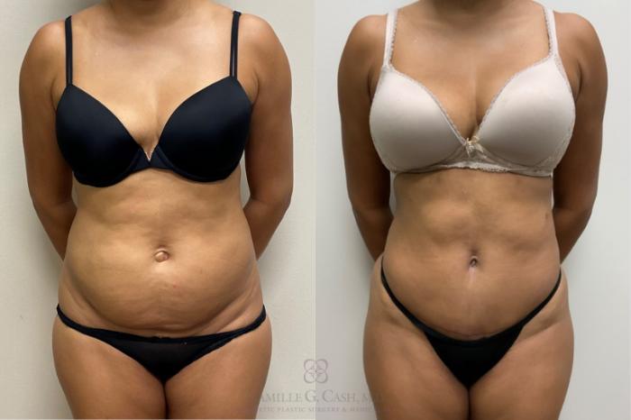 Abdominoplasty