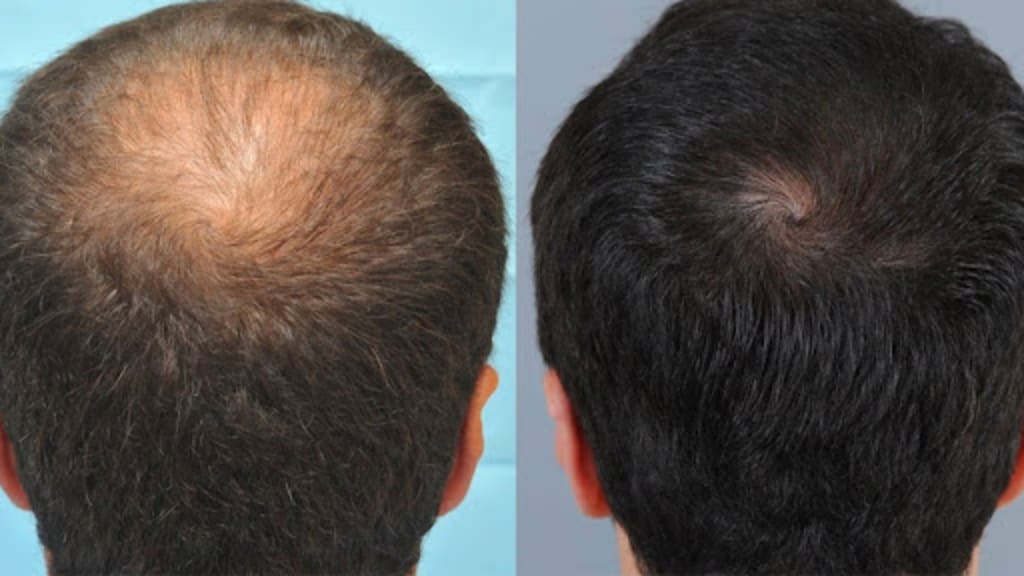 FUE Therapy | Hair Transplant