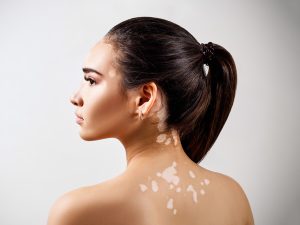 Vitiligo Or White Mark Correction