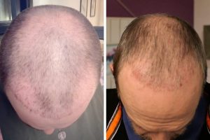 FUT Therapy | Hair Transplant